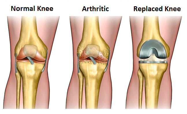 Knee replacement Singapore