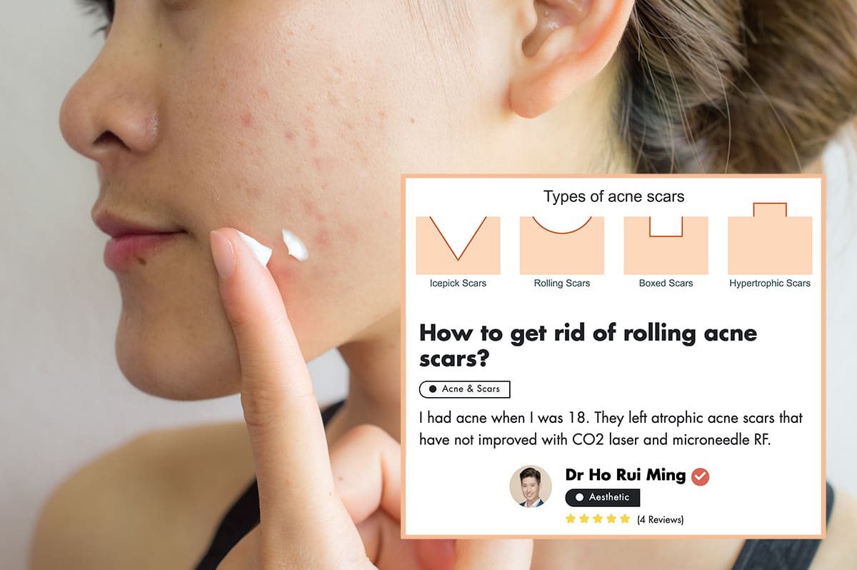 Masturbation for acne