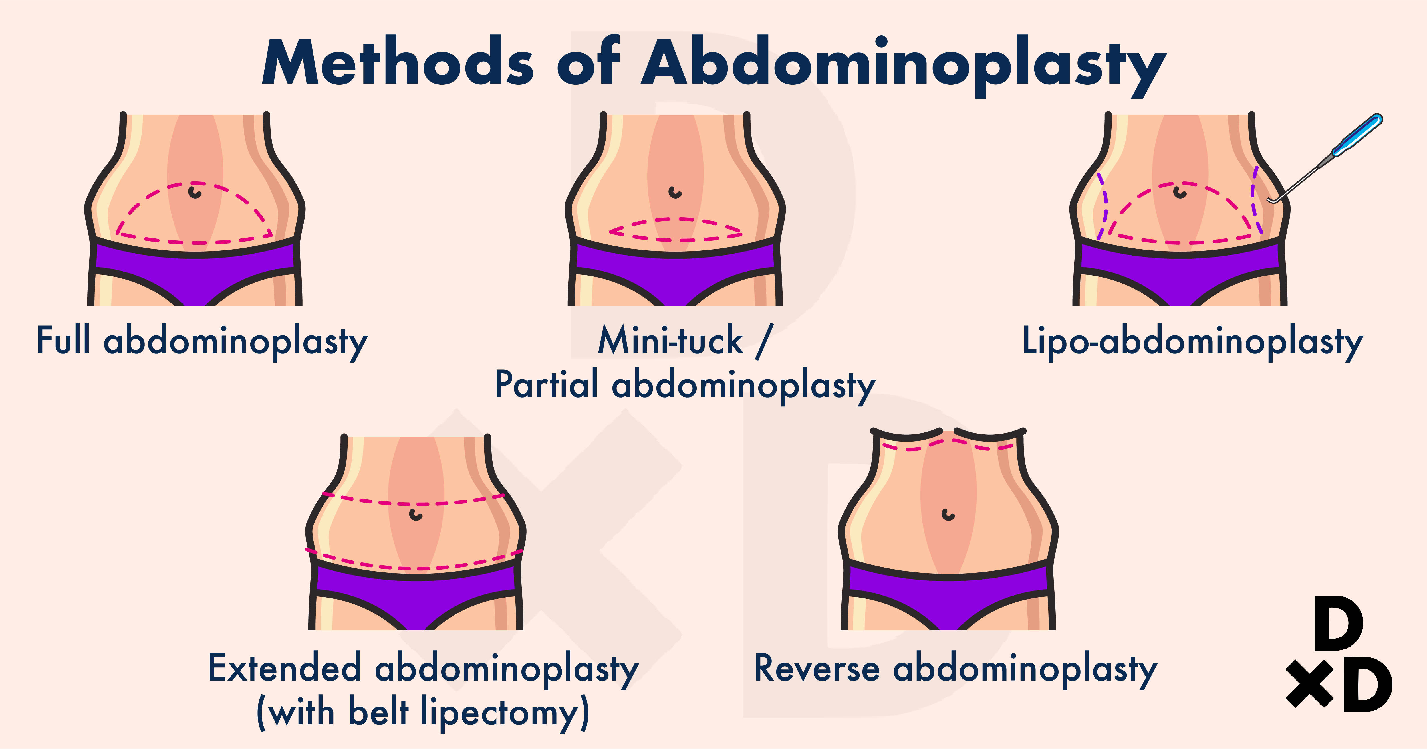 Tummy Tuck Your Guide To Getting An Abdominoplasty In Singapore Human