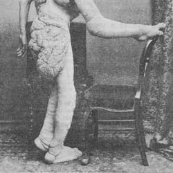Elephant Man