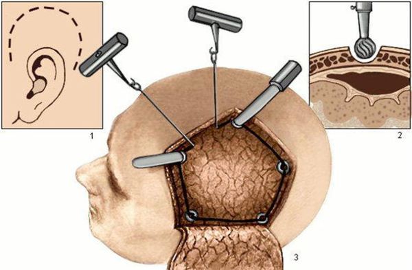 Трепанация черепа