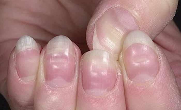 grooves dents in nails pictures