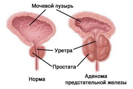 Схематическое изображение аденомы предстательной железы