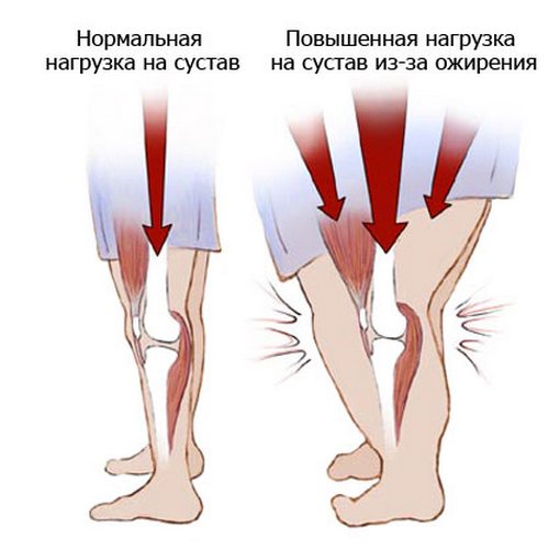 Остеопороз