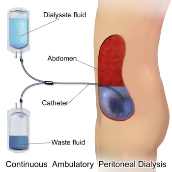 PD is a more affordable form of dialysis because it does not require a machine or specialized dialysis facility for treatment. (Image courtesy of Wikipedia.)