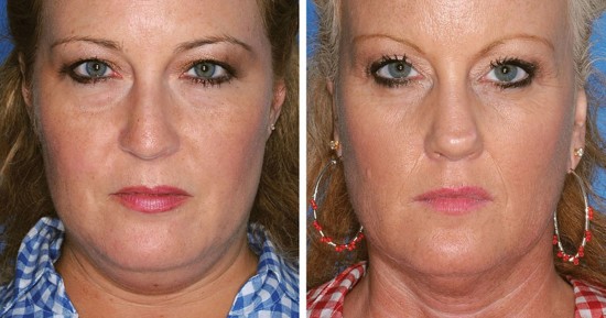 kuva: American Society of Plastic Surgeons / Rex Feature / AOP