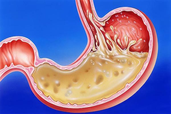 HEAL gastritis WITH SMART FOOD HEAL gastritis WITH SMART FOOD