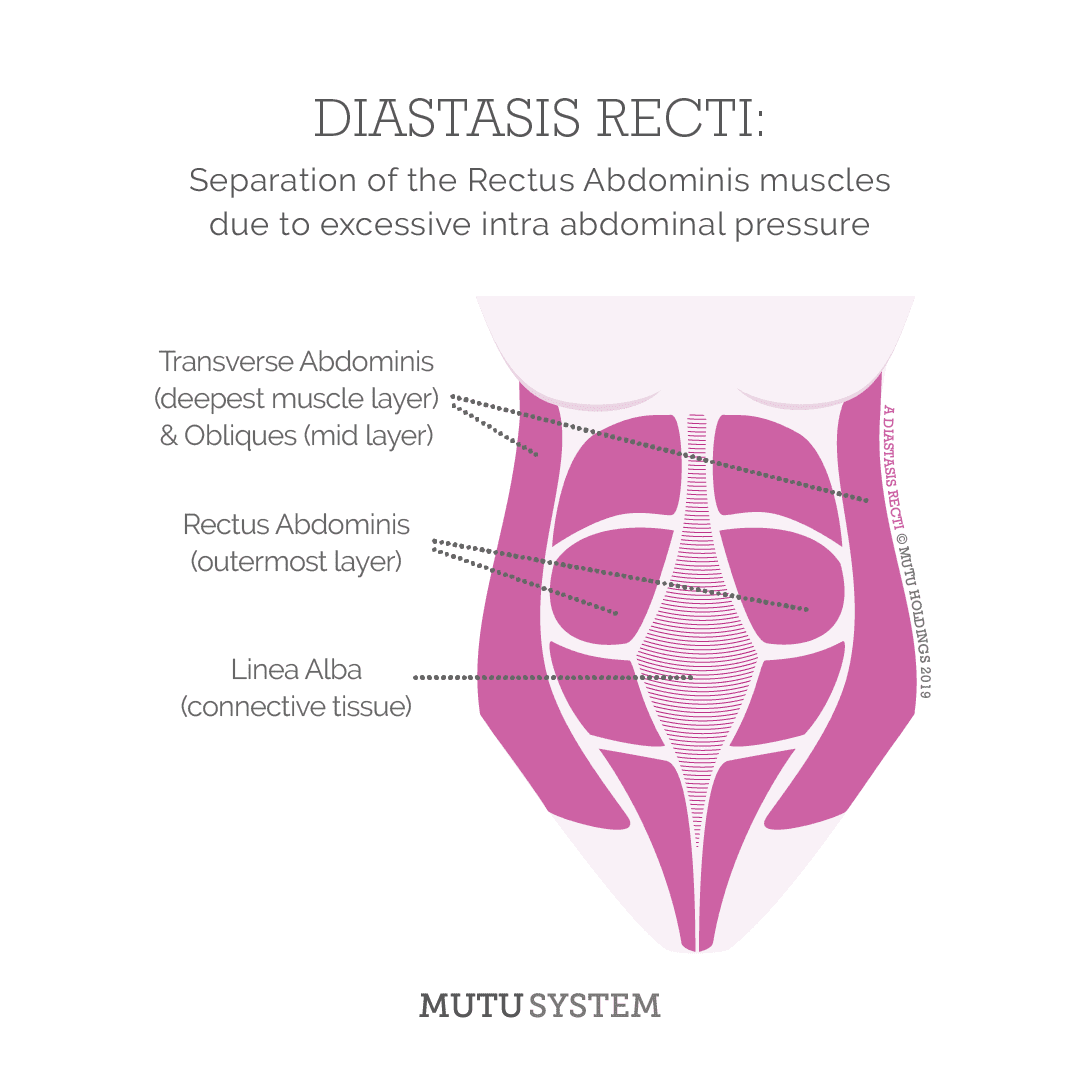 Diastasis Recti
