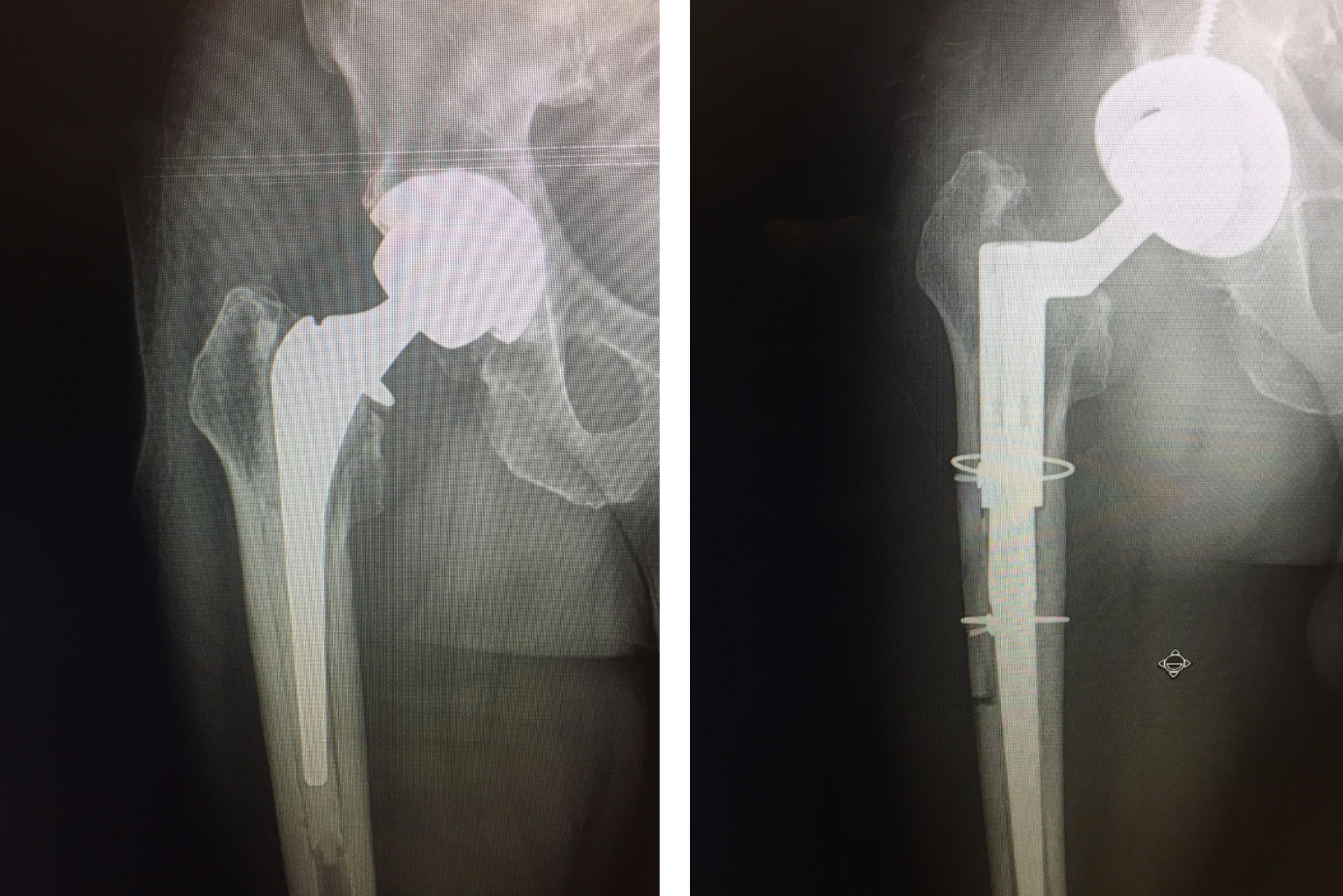 How Soon After Hip Replacement Can I Donate Blood