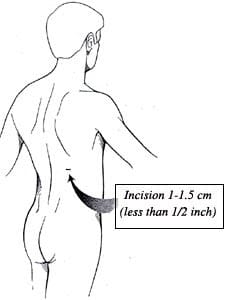 Kidney Stone Incision Diagram