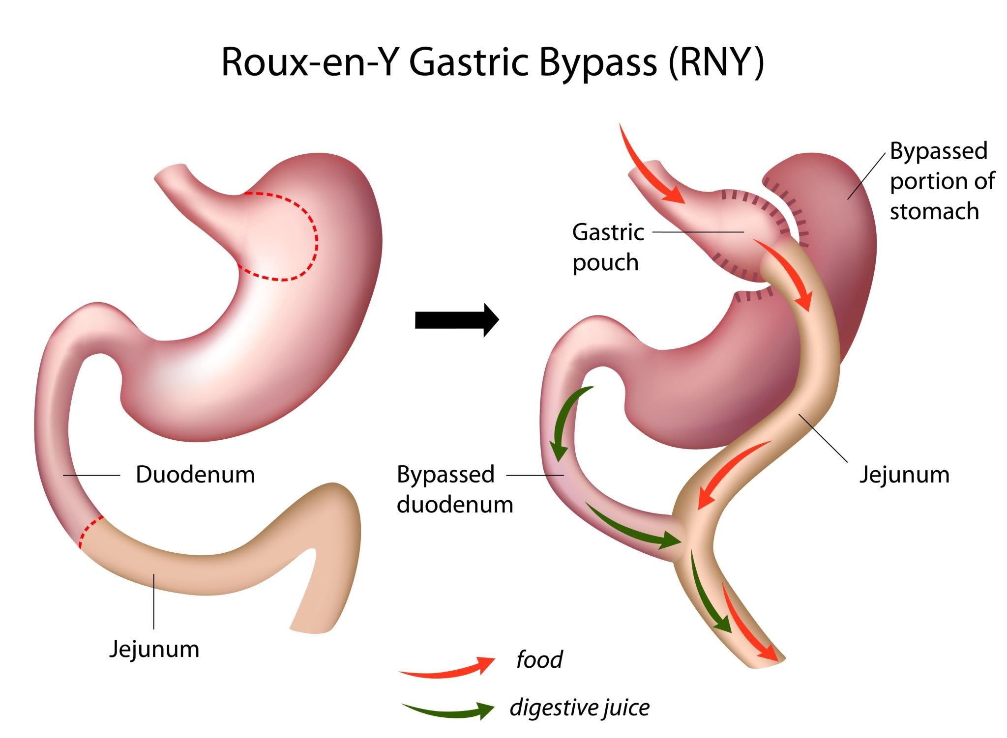 Roux-en-Y Gastric Bypass (RNY)