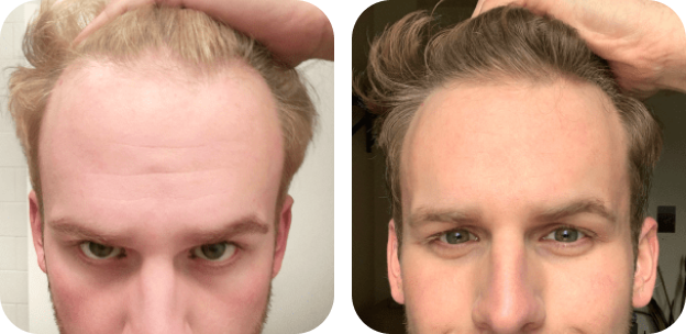 How Long Before Minoxidil | hims