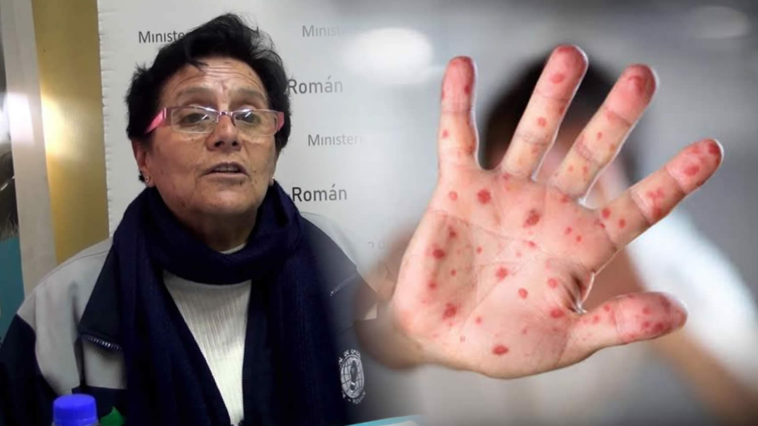 Sarampión Alarma en San Román: 897 Casos y el 50% de Contagios en Ecuador