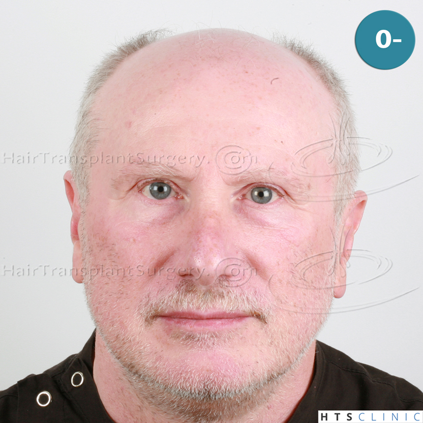 Dr.Devroye-HTS-Clinic-5473_2867-FUT_2606-FUE_-NW-VI-1.jpg