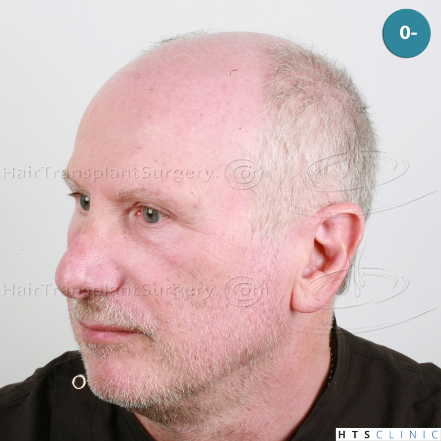 Dr.Devroye-HTS-Clinic-5473_2867-FUT_2606-FUE_-NW-VI-3.jpg