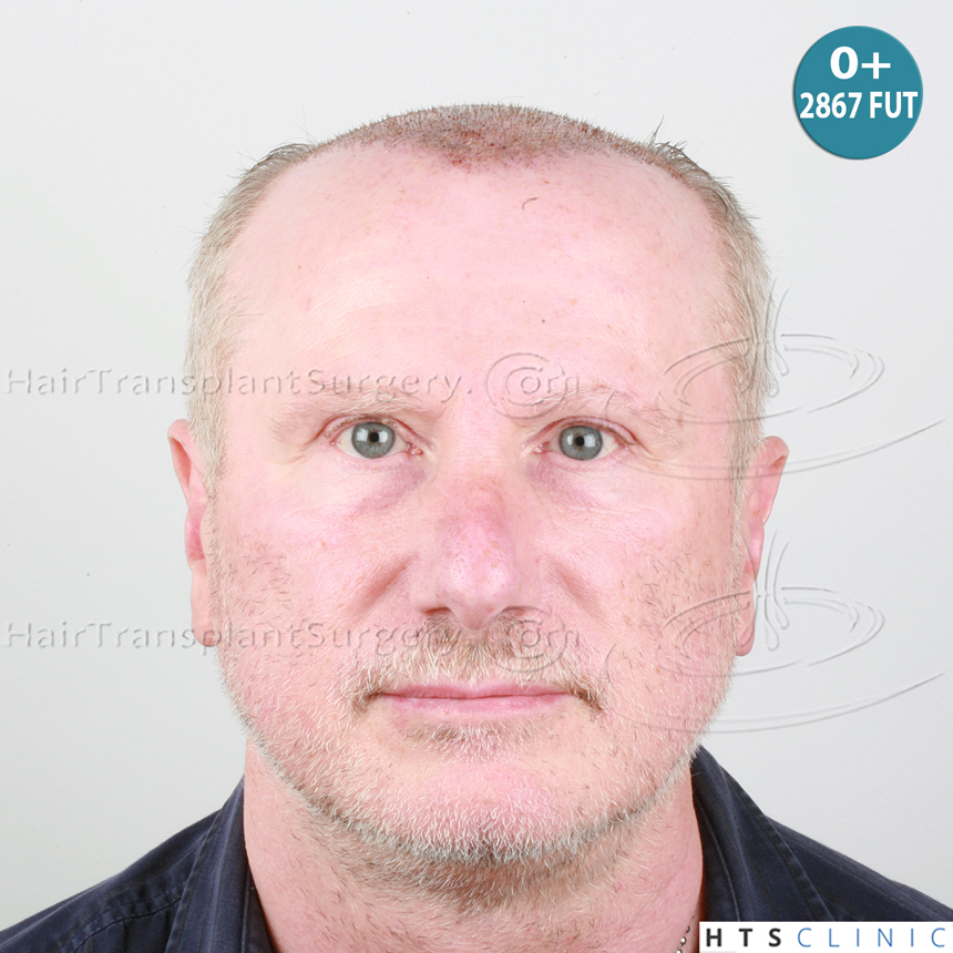 Dr.Devroye-HTS-Clinic-5473_2867-FUT_2606-FUE_-NW-VI-7.jpg