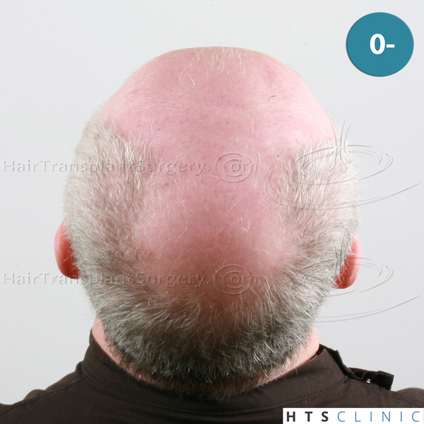 Dr.Devroye-HTS-Clinic-5473_2867-FUT_2606-FUE_-NW-VI-6.jpg
