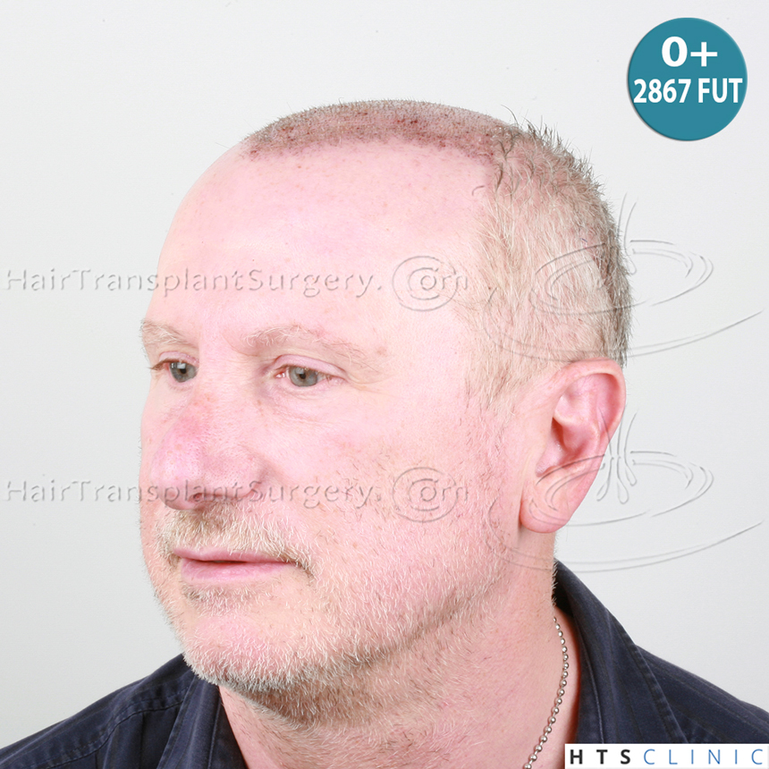 Dr.Devroye-HTS-Clinic-5473_2867-FUT_2606-FUE_-NW-VI-9.jpg