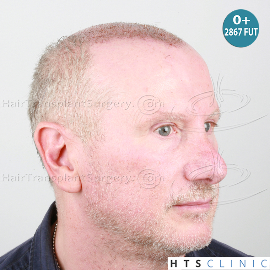 Dr.Devroye-HTS-Clinic-5473_2867-FUT_2606-FUE_-NW-VI-10.jpg