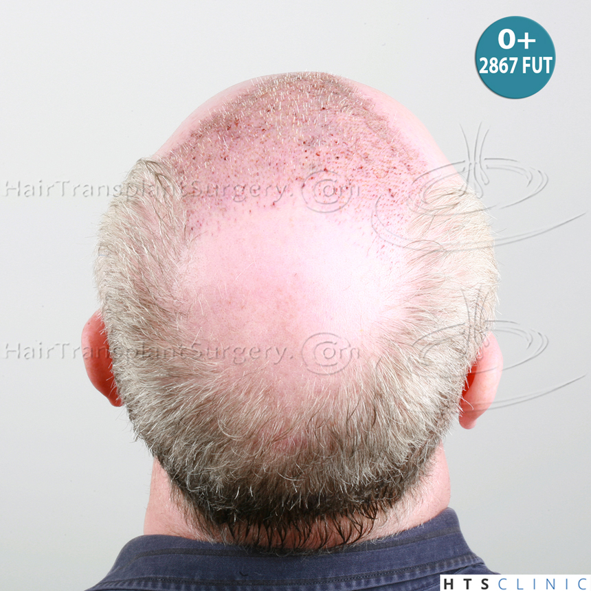 Dr.Devroye-HTS-Clinic-5473_2867-FUT_2606-FUE_-NW-VI-12.jpg