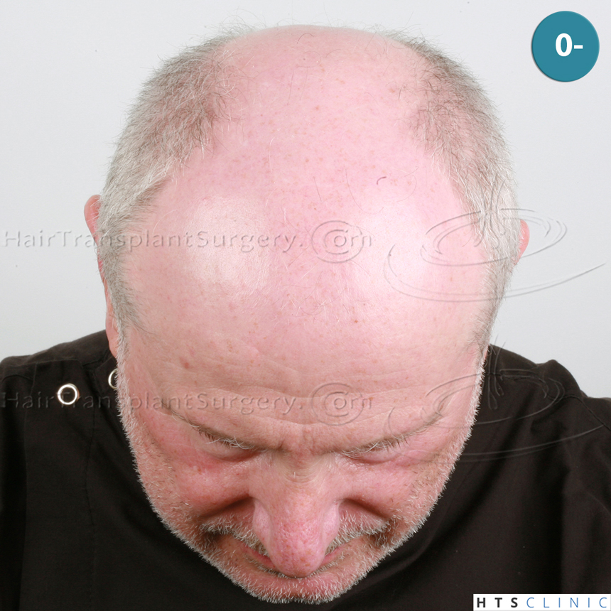 Dr.Devroye-HTS-Clinic-5473_2867-FUT_2606-FUE_-NW-VI-2.jpg