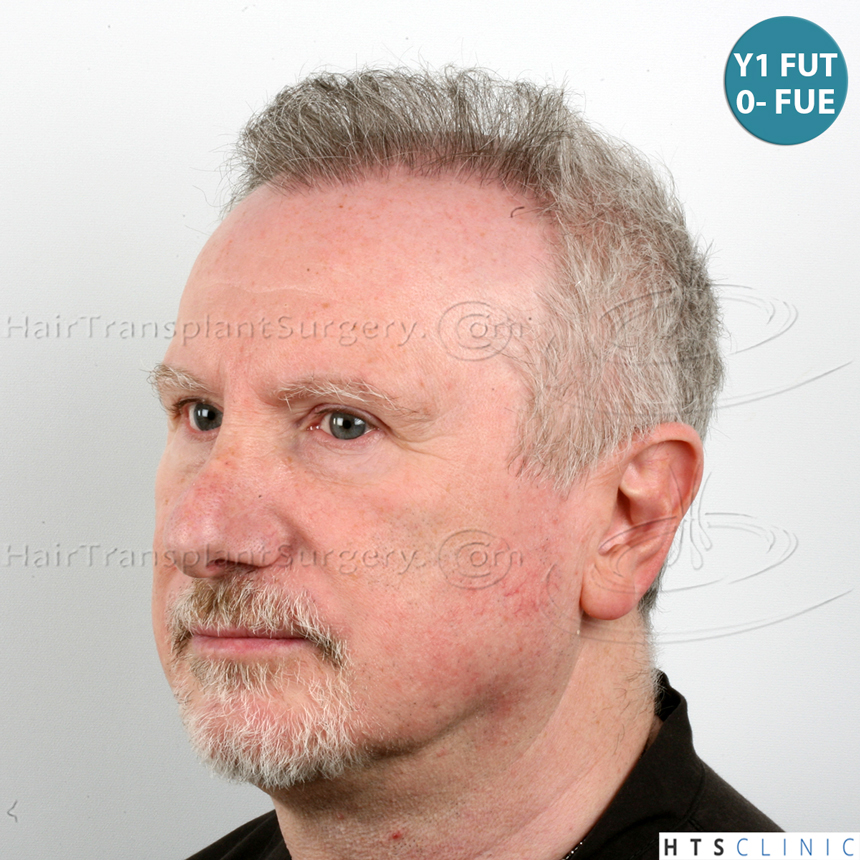 Dr.Devroye-HTS-Clinic-5473_2867-FUT_2606-FUE_-NW-VI-15.jpg