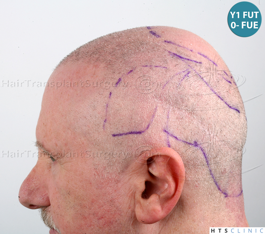 Dr.Devroye-HTS-Clinic-5473_2867-FUT_2606-FUE_-NW-VI-20.jpg