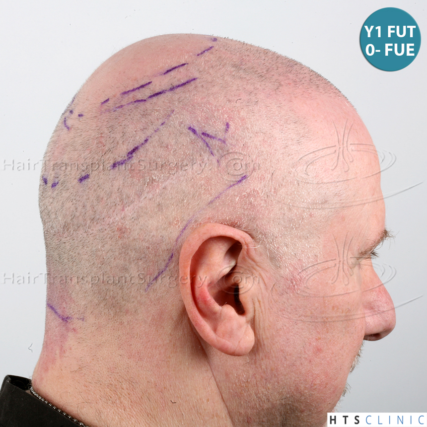 Dr.Devroye-HTS-Clinic-5473_2867-FUT_2606-FUE_-NW-VI-21.jpg