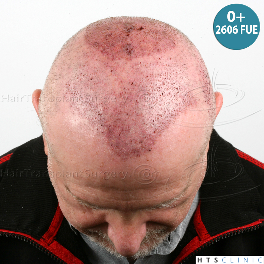 Dr.Devroye-HTS-Clinic-5473_2867-FUT_2606-FUE_-NW-VI-23.jpg