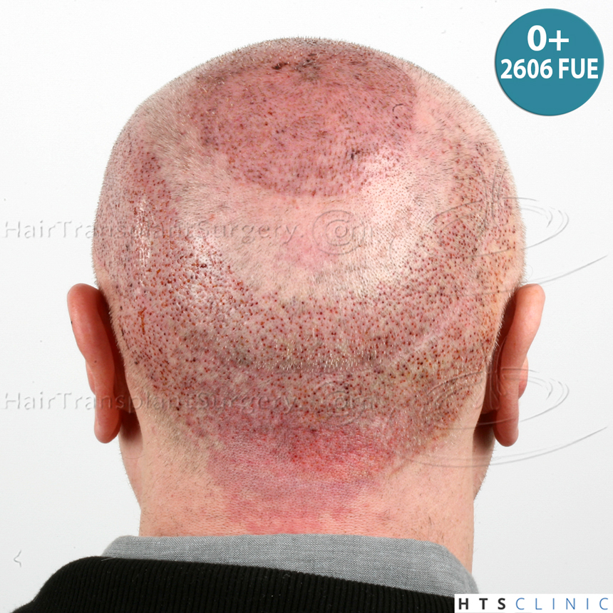 Dr.Devroye-HTS-Clinic-5473_2867-FUT_2606-FUE_-NW-VI-24.jpg