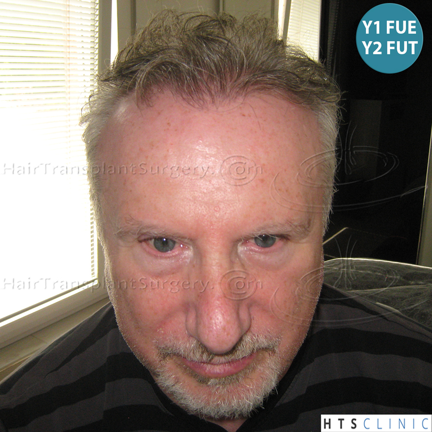 Dr.Devroye-HTS-Clinic-5473_2867-FUT_2606-FUE_-NW-VI-26.jpg