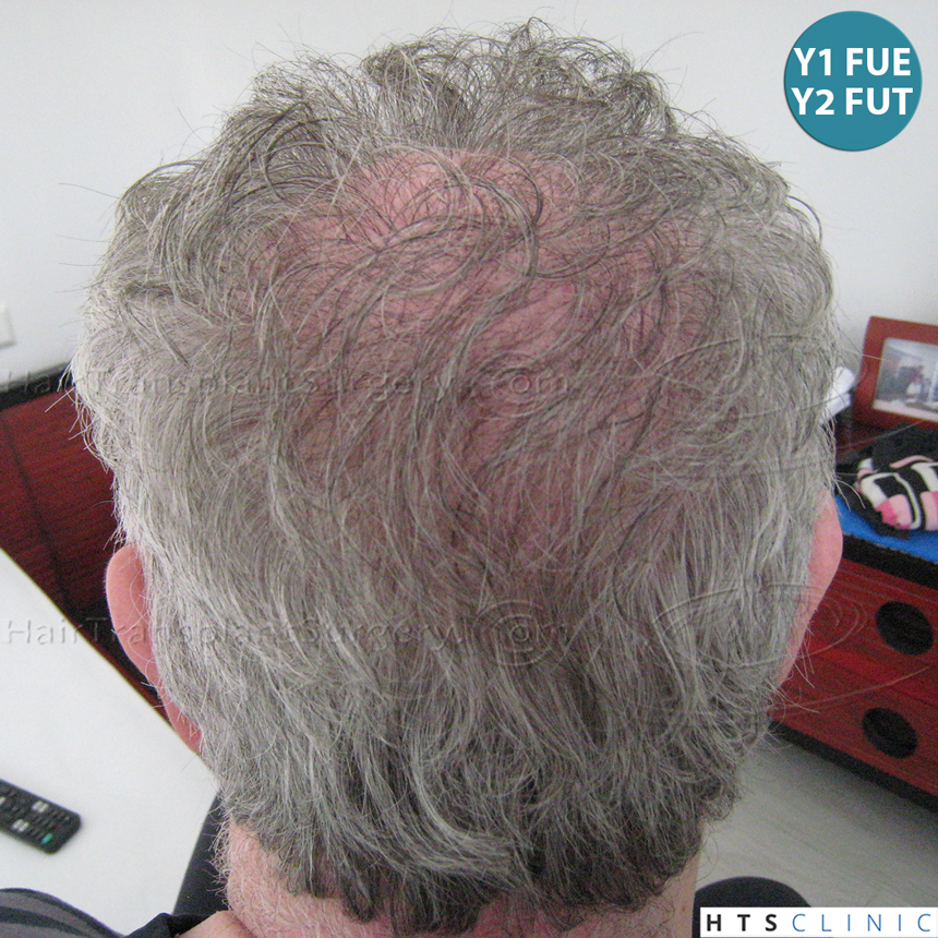 Dr.Devroye-HTS-Clinic-5473_2867-FUT_2606-FUE_-NW-VI-28.jpg
