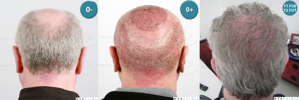 Dr.Devroye-HTS-Clinic-5473_2867-FUT_2606-FUE_-NW-VI-Montage2.jpg