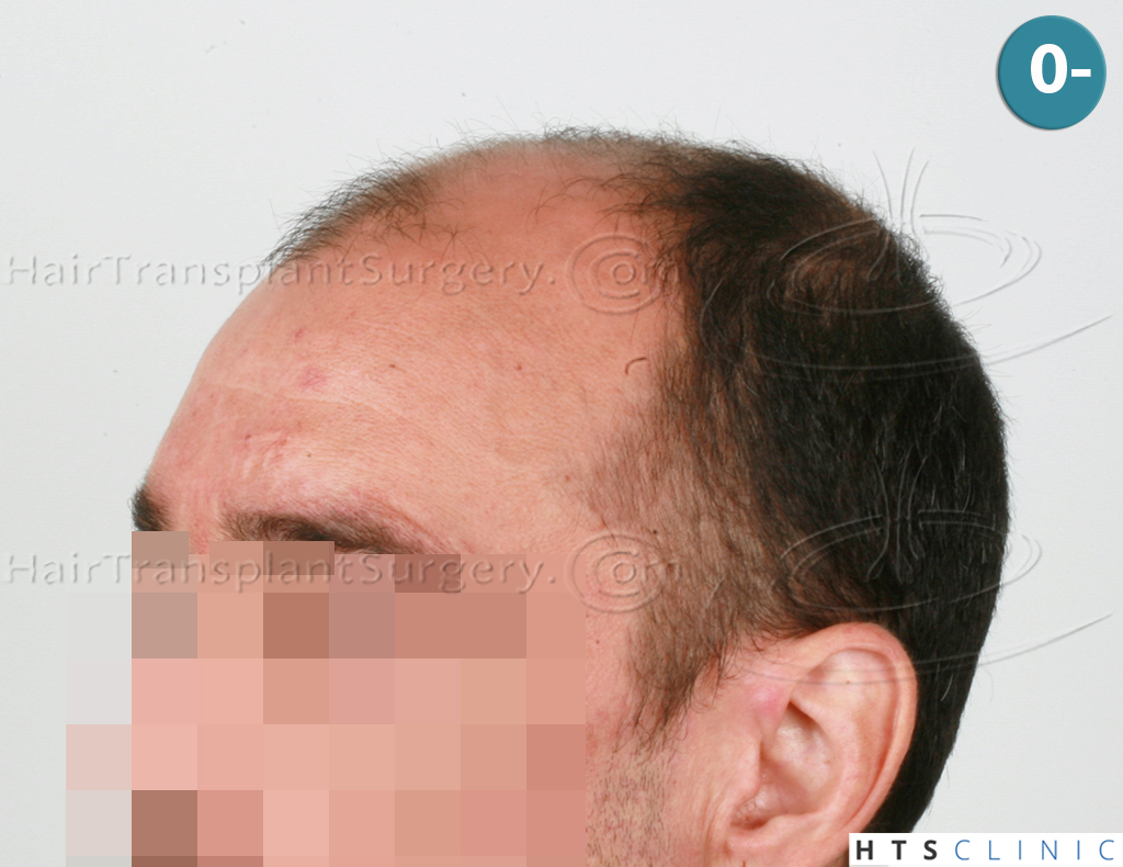 Dr.Devroye-HTS-clinic-4279-FUE-NW-VI-2.jpg