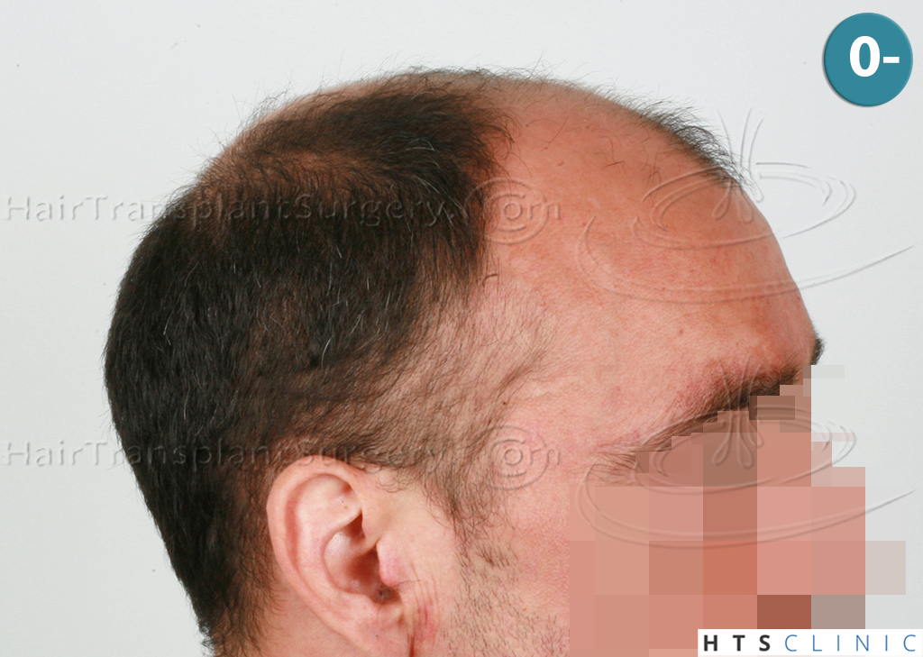 Dr.Devroye-HTS-clinic-4279-FUE-NW-VI-3