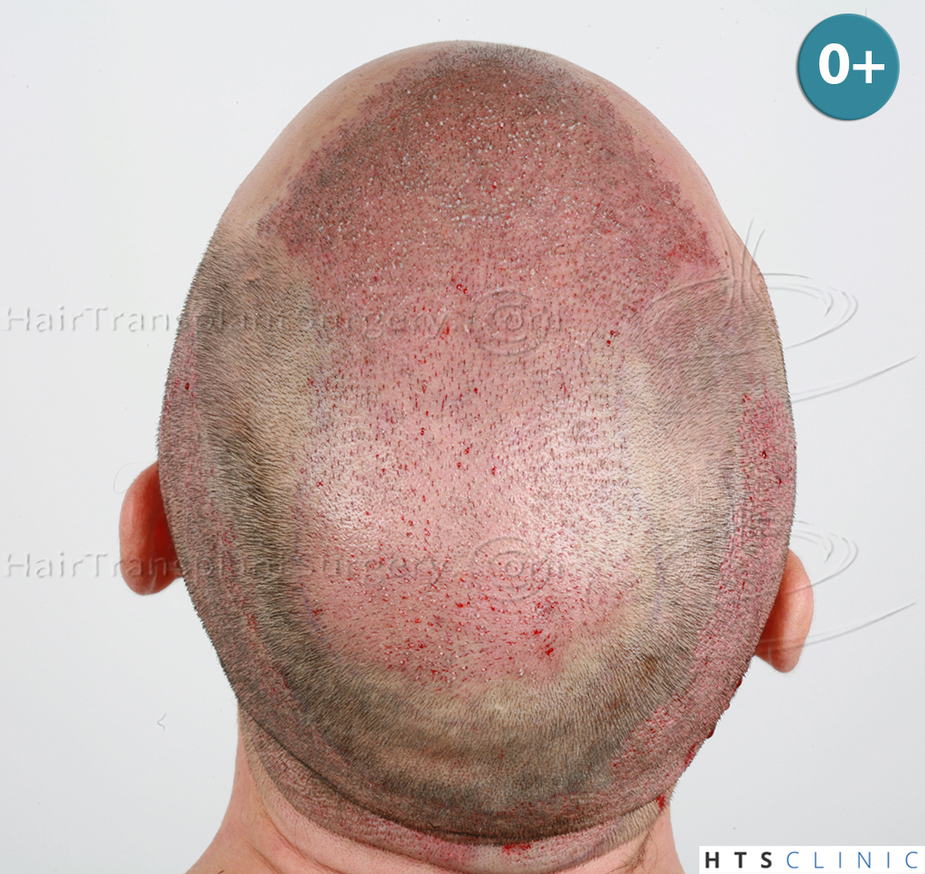 Dr.Devroye-HTS-clinic-4279-FUE-NW-VI-6