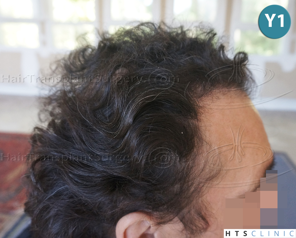 Dr.Devroye-HTS-clinic-4279-FUE-NW-VI-10