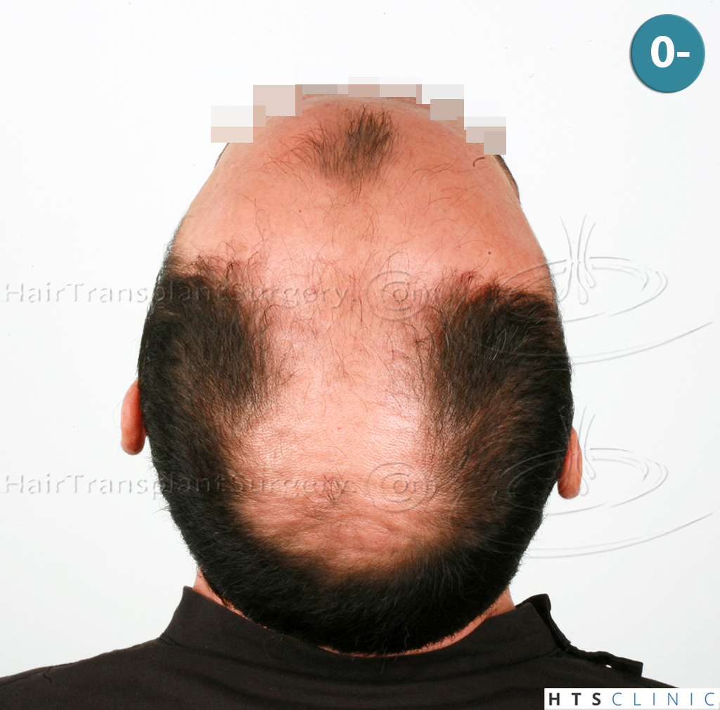 Dr.Devroye-HTS-clinic-4279-FUE-NW-VI-4