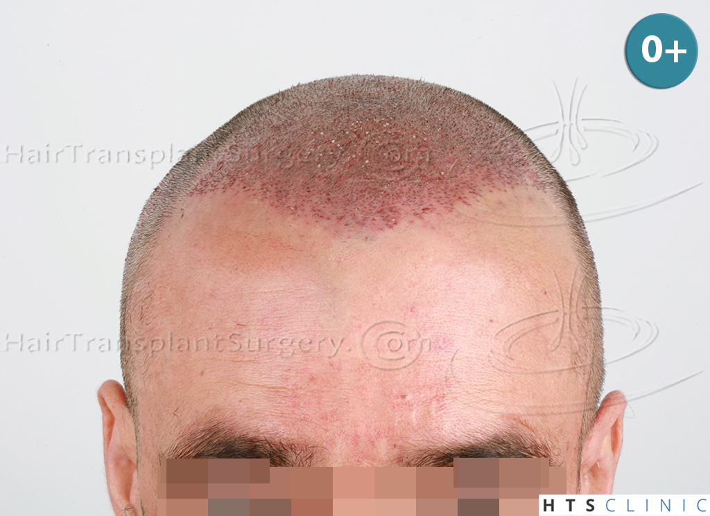 Dr.Devroye-HTS-clinic-4279-FUE-NW-VI-5