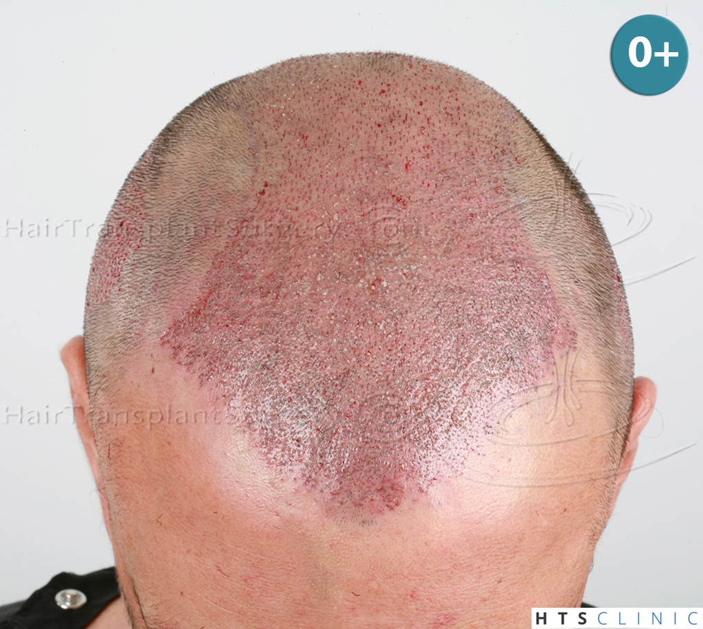 Dr.Devroye-HTS-clinic-4279-FUE-NW-VI-7