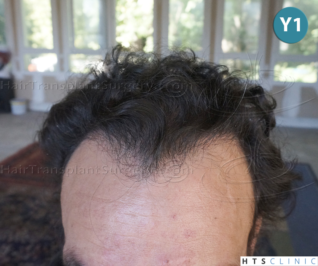 Dr.Devroye-HTS-clinic-4279-FUE-NW-VI-8
