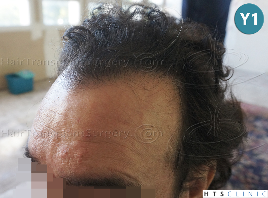 Dr.Devroye-HTS-clinic-4279-FUE-NW-VI-9