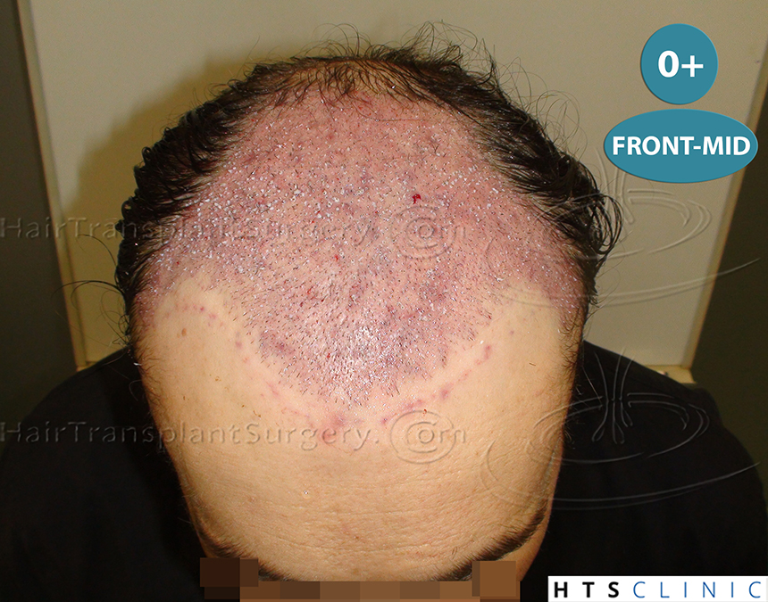 Dr.Devroye-HTS-clinic-4063-FUT-Repair-7BG.jpg