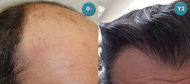 Dr.Devroye-HTS-clinic-4063-FUT-Repair-1old.jpg