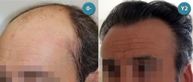 Dr.Devroye-HTS-clinic-4063-FUT-Repair-2old.jpg
