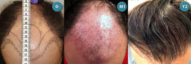 Dr.Devroye-HTS-clinic-4063-FUT-Repair-3old.jpg