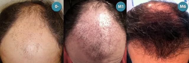 Dr.Devroye-HTS-clinic-4063-FUT-Repair-4old.jpg