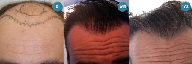 Dr.Devroye-HTS-clinic-4063-FUT-Repair-5old.jpg