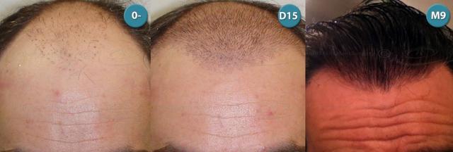 Dr.Devroye-HTS-clinic-4063-FUT-Repair-6old.jpg
