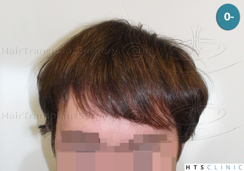 Dr.Devroye-HTS-Clinic-1793-FUT-NW-IIA-1.jpg